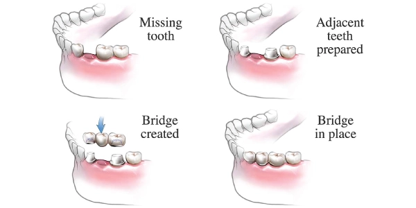 Crown And Bridge Treatment Process Explained | Carve Dental Studio | Gota | Ahmedabad | Gujarat