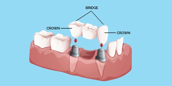 Crowns And Bridges | Carve Dental Studio | Gota | Ahmedabad | Gujarat
