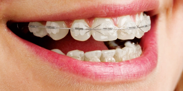Extractions and Braces Addressing Crowding for Optimal Orthodontic Results | Carve Dental Studio | Gota | Ahmedabad | Gujarat