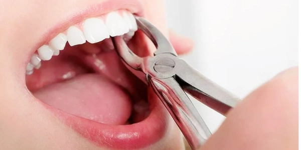 Extractions | Carve Dental Studio | Gota | Ahmedabad | Gujarat