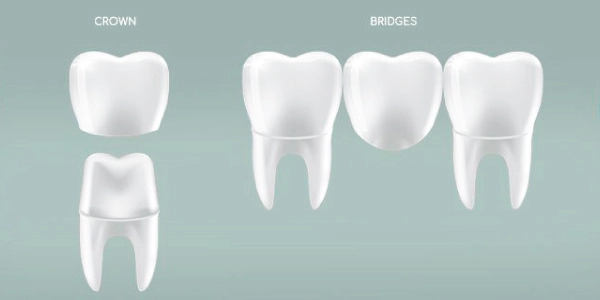 The Difference between Crowns and Bridges | Carve Dental Studio | Gota | Ahmedabad | Gujarat