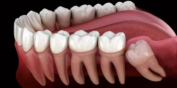 Wisdom Teeth Extractions Managing Impacted Teeth and Discomfort | Carve Dental Studio | Gota | Ahmedabad | Gujarat